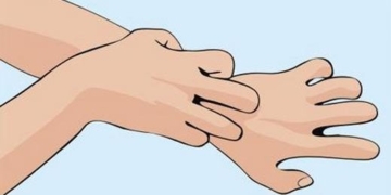 What are causes of scabies? Symptoms, treatment and home remedies