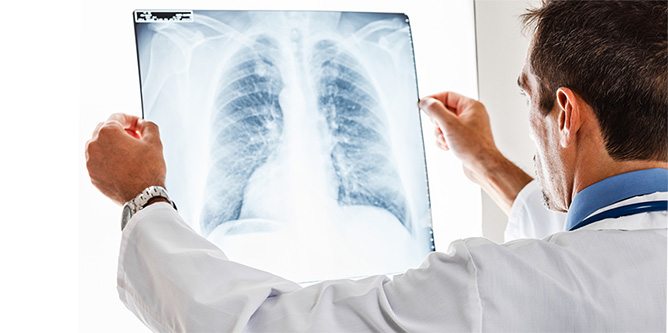 Read more about the article Lung infection and inflammation: Causes, symptoms and treatment