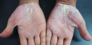 psoriasis