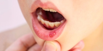 What is a canker sore? Causes, symptoms and treatment of aphthous ulcers
