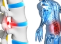 Sciatica Pain Guide: Symptoms, Causes, Treatments, and Exercise