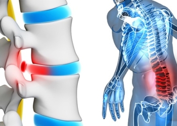 Sciatica Pain Guide: Symptoms, Causes, Treatments, and Exercise