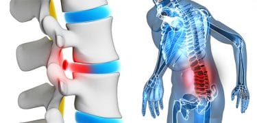 Lee más sobre el artículo ¿Qué es la hernia discal lumbar? Causas, síntomas y tratamiento
