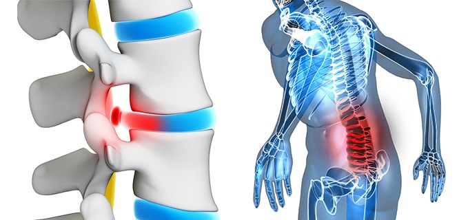 En este momento estás viendo ¿Qué es la hernia discal lumbar? Causas, síntomas y tratamiento