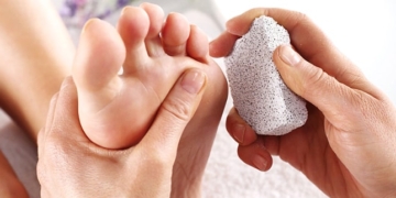 ¿Qué es el callo? Causas, síntomas, tratamiento y remedios caseros