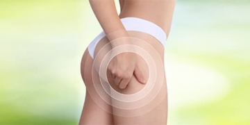 ¿Qué es la celulitis? Tipos, causas y tratamientos naturales