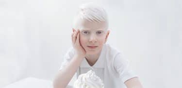 albinism 