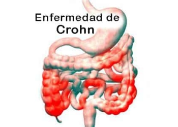 ¿Qué es la enfermedad de Crohn? Causas, Síntomas y Tratamiento