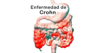 ¿Qué es la enfermedad de Crohn? Causas, Síntomas y Tratamiento