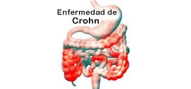 Lee más sobre el artículo ¿Qué es la enfermedad de Crohn? Causas, Síntomas y Tratamiento