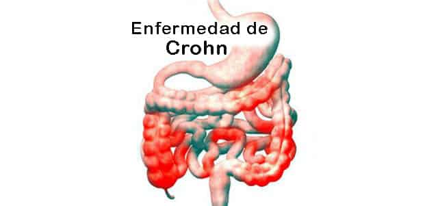 En este momento estás viendo ¿Qué es la enfermedad de Crohn? Causas, Síntomas y Tratamiento