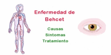 ¿Qué es la enfermedad de Behcet y por qué ocurre? Síntomas y tratamiento