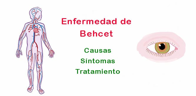 En este momento estás viendo ¿Qué es la enfermedad de Behcet y por qué ocurre? Síntomas y tratamiento