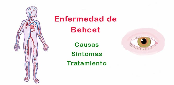 Lee más sobre el artículo ¿Qué es la enfermedad de Behcet y por qué ocurre? Síntomas y tratamiento