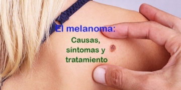 ¿Qué es el cáncer de piel tipo melanoma? Causas, síntomas y tratamiento
