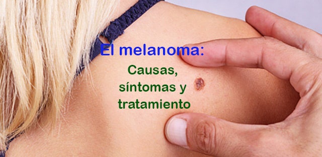 Lee más sobre el artículo ¿Qué es el cáncer de piel tipo melanoma? Causas, síntomas y tratamiento