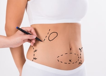 Fettabsaugung (Liposuktion): Ablauf, Risiken, Vorteile und Kosten