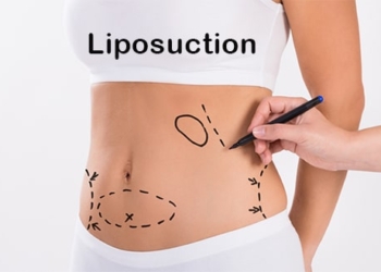 Что такое липосакция? Преимущества и побочные эффекты