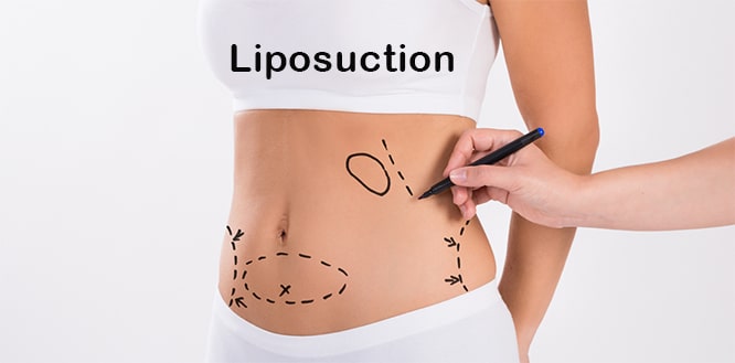 You are currently viewing What is Liposuction? Is it safe? Uses, benefits and side effects