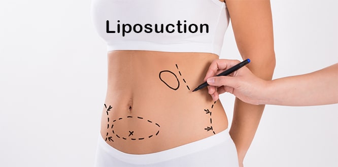 Read more about the article What is Liposuction? Is it safe? Uses, benefits and side effects