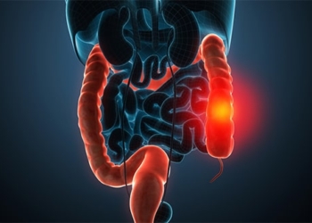 Was ist Colitis ulcerosa? Ursachen, Symptome und Behandlung