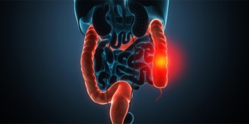 Was ist Colitis ulcerosa? Ursachen, Symptome und Behandlung