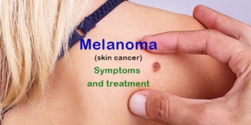 What is Melanoma? Symptoms and treatment of skin cancer