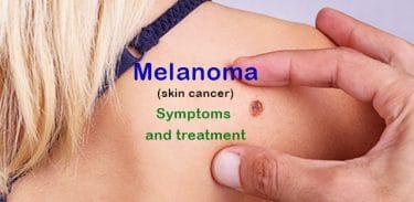 Read more about the article What is Melanoma? Symptoms and treatment of skin cancer