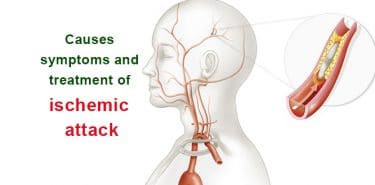 Read more about the article What is ischemia? Causes, symptoms and treatment of ischemic attack