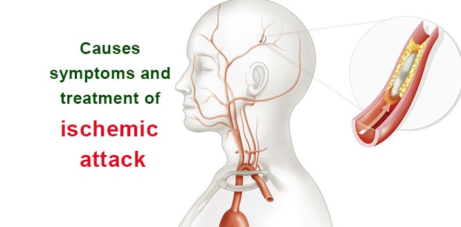 You are currently viewing What is ischemia? Causes, symptoms and treatment of ischemic attack