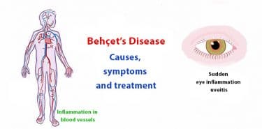 Read more about the article Behçet’s Disease: Causes, symptoms, treatment and lifestyle tips