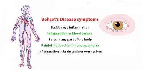 Behçet’s Disease: Causes, symptoms, treatment and lifestyle tips