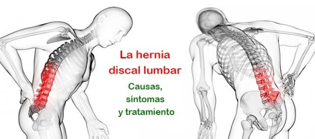 Ejercicios para la ciatica debido a una hernia discal