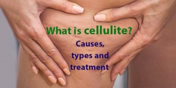 What is cellulite? Causes, types, treatment and home-made cures