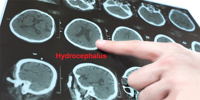 You are currently viewing What is hydrocephalus? Causes, symptoms and treatment