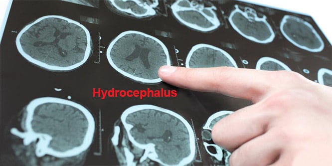 Read more about the article What is hydrocephalus? Causes, symptoms and treatment