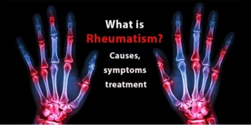 What is rheumatism? Causes, symptoms and treatment