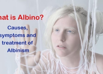 What is Albino? Causes, symptoms and treatment of Albinism