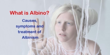 What is Albino? Causes, symptoms and treatment of Albinism