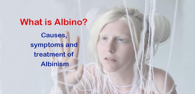 You are currently viewing What is Albino? Causes, symptoms and treatment of Albinism