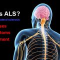 What is ALS? Causes, symptoms, treatment and recommendations