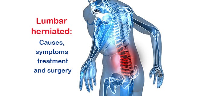 You are currently viewing What is lumbar herniated disc? Causes, symptoms and treatment