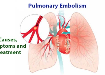 What is pulmonary embolism? Causes, symptoms and treatment