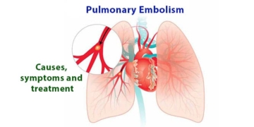 What is pulmonary embolism? Causes, symptoms and treatment