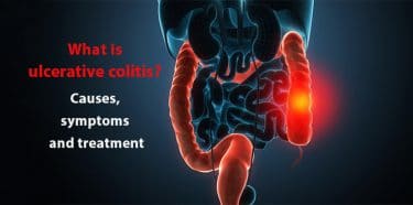 Read more about the article What is ulcerative colitis? Causes, symptoms and treatment