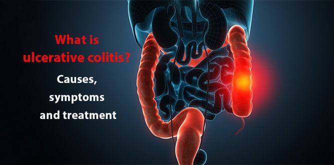 You are currently viewing What is ulcerative colitis? Causes, symptoms and treatment
