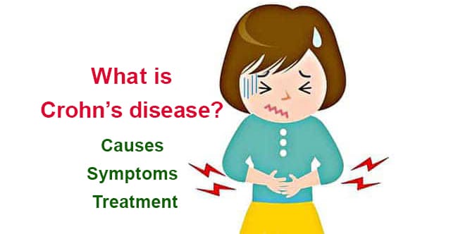 You are currently viewing What is Crohn’s disease? Causes, symptoms and treatment