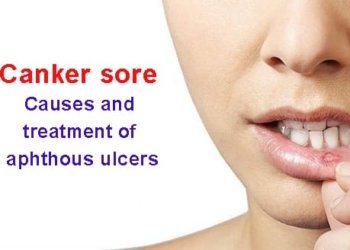What is a canker sore? Causes, symptoms and treatment of aphthous ulcers