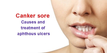 What is a canker sore? Causes, symptoms and treatment of aphthous ulcers