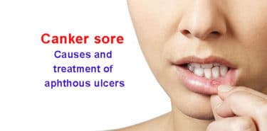 Read more about the article What is a canker sore? Causes, symptoms and treatment of aphthous ulcers